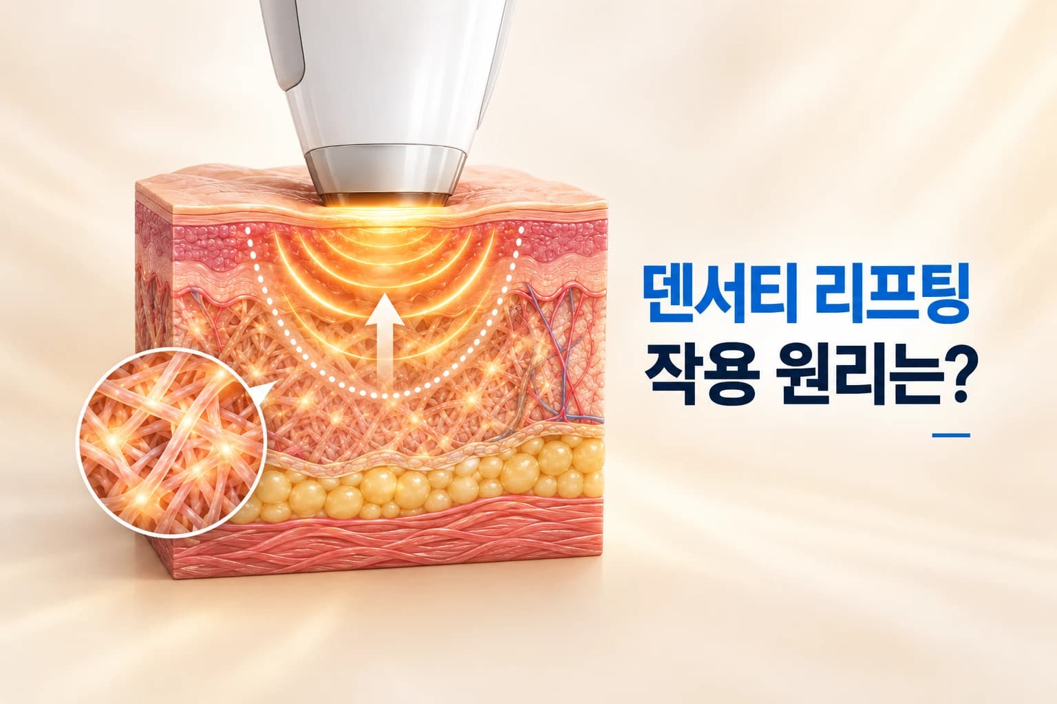 덴서티 팁과 모노폴라·바이폴라 고주파가 피부 진피층에 전달되는 덴서티 리프팅 원리 썸네일