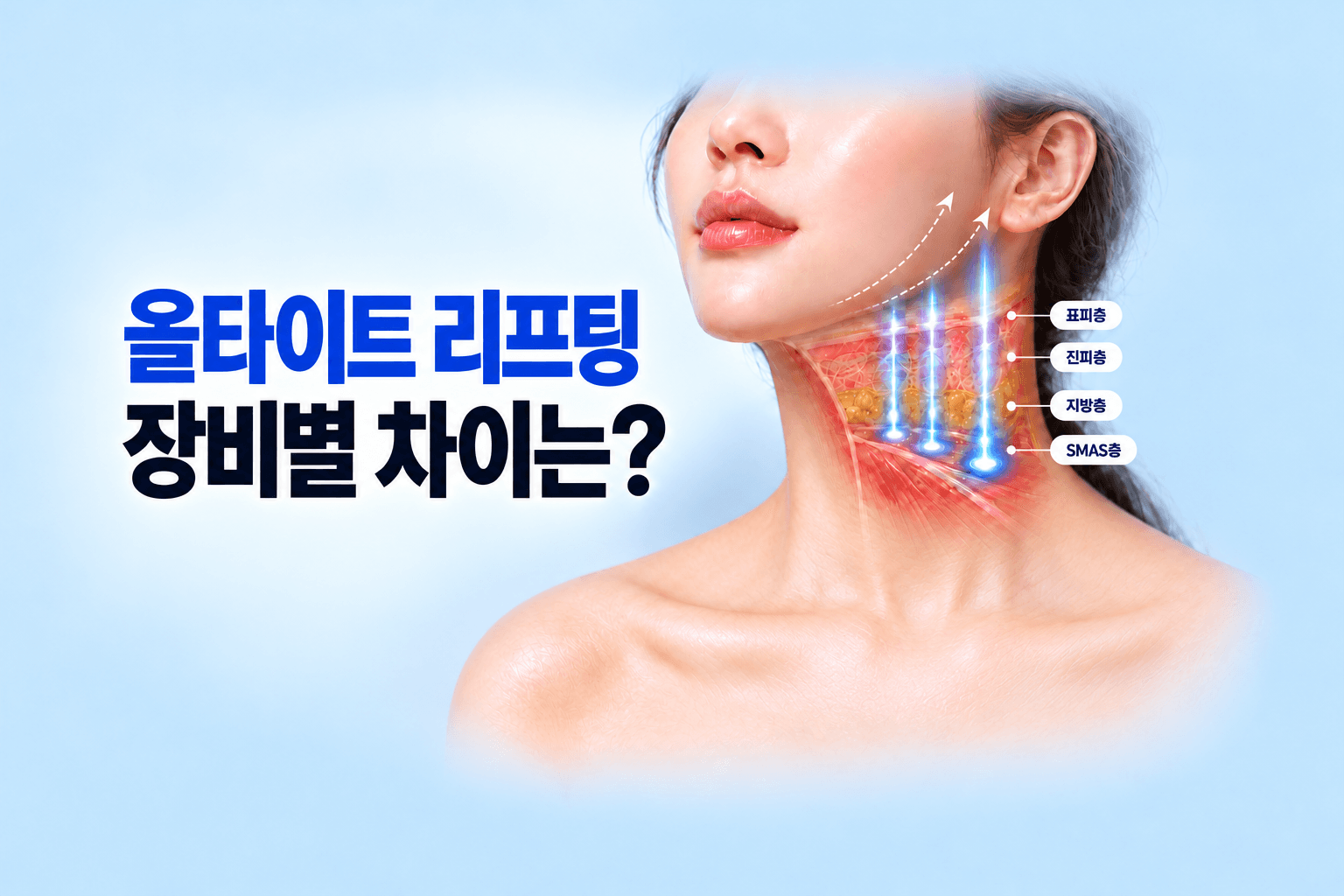 핸드피스 팁과 유전가열 에너지가 진피와 근막층에 닿는 피부 단면을 담은 올타이트 리프팅 썸네일