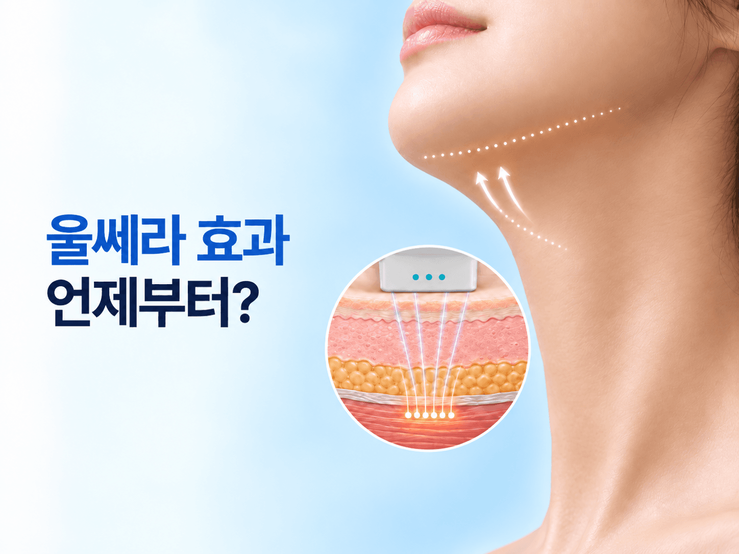 울쎄라 핸드피스 팁이 턱선 피부에 닿고 근막층에 열응고점이 생기는 울쎄라 효과 시기 썸네일