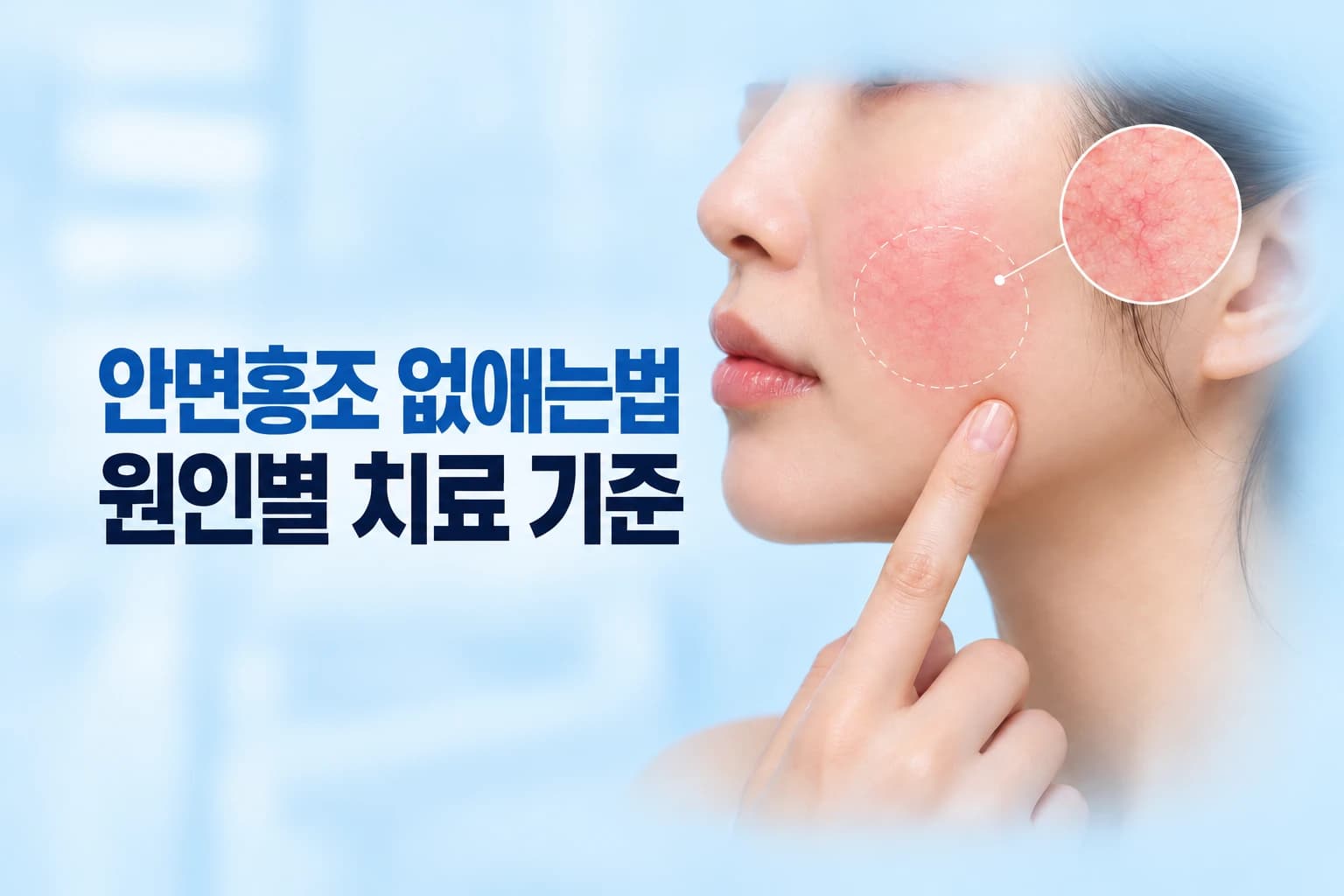 볼의 붉은 홍조 부위에 닿는 레이저 빛과 확장된 모세혈관 인셋을 조합한 안면홍조 없애는법 썸네일