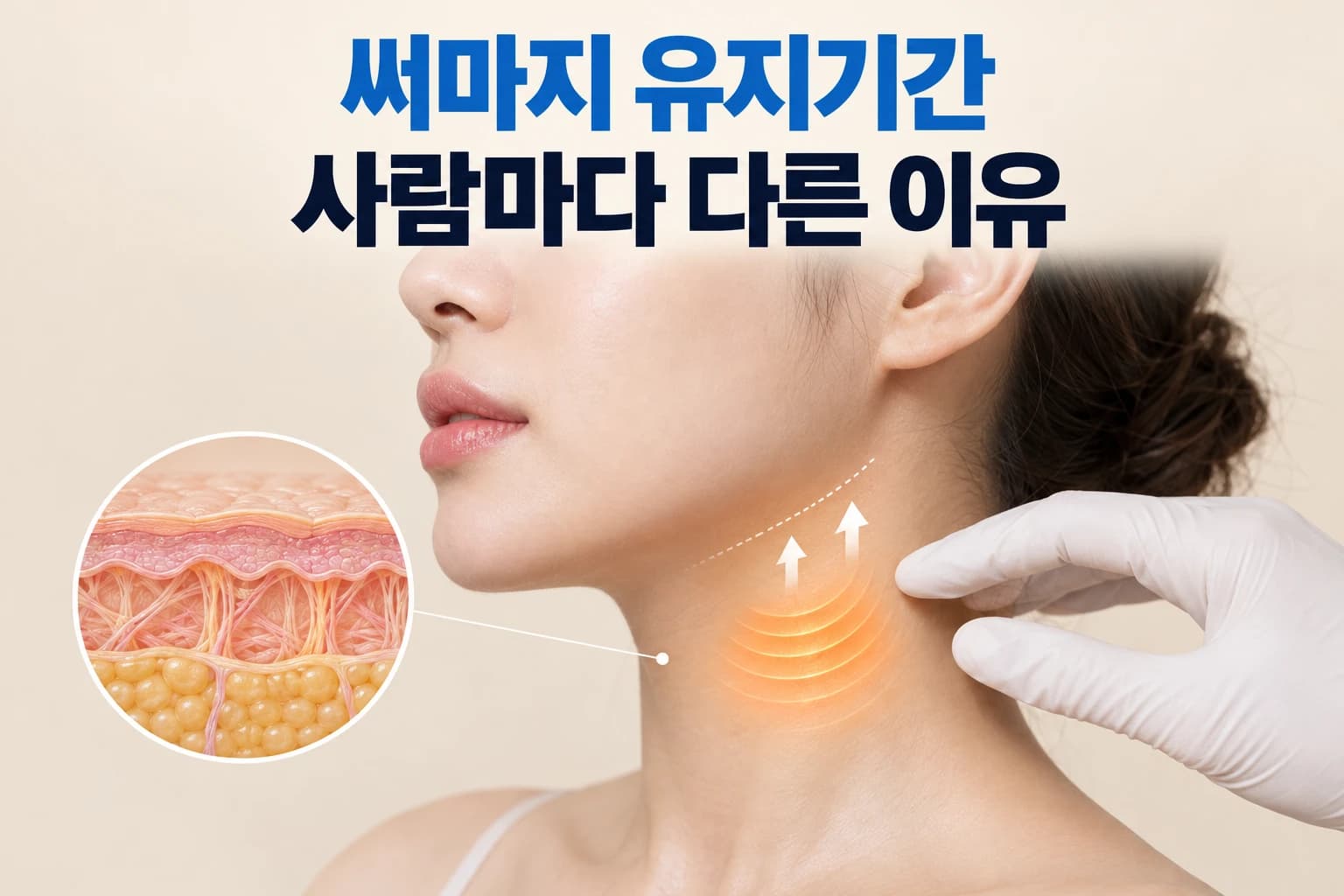 고주파 핸드피스 팁이 턱선 피부에 닿아 진피 콜라겐에 열을 전달하는 써마지 유지기간 썸네일